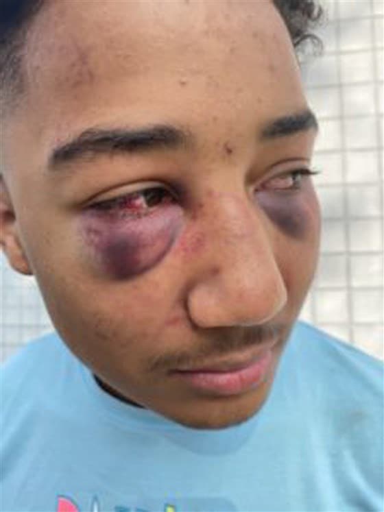 Family files lawsuit after officers allegedly beat Black teen