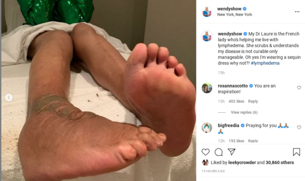 ‘Prayers to Wendy’: Wendy Williams Opens Up About Her Struggle with Lymphedema By Sharing a Shocking New Image