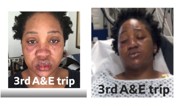 ‘Had to Fight’ to be Treated: Black Woman Nearly Died of Rare Skin Disorder After Being Sent Home from Two Hospitals Because Doctors Didn’t Recognize Her Symptoms