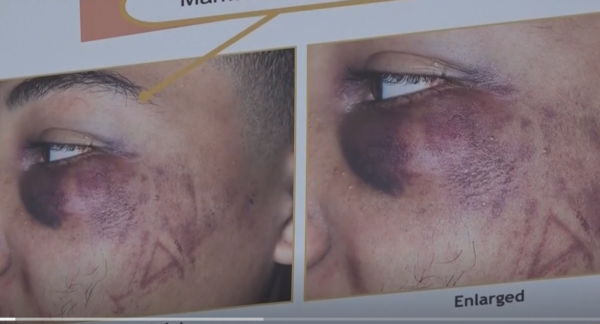 ‘A Helpless Teenager’: Grand Jury Indicts Former Stockton Police Officers In Beating of Black Teen That Left Boot Print on His Face