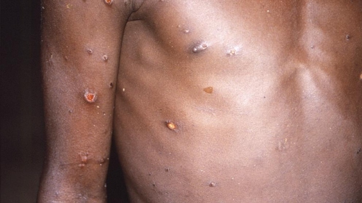 Monkeypox reported in 26 states. Here’s info on vaccine side effects and who should consider getting the shot 