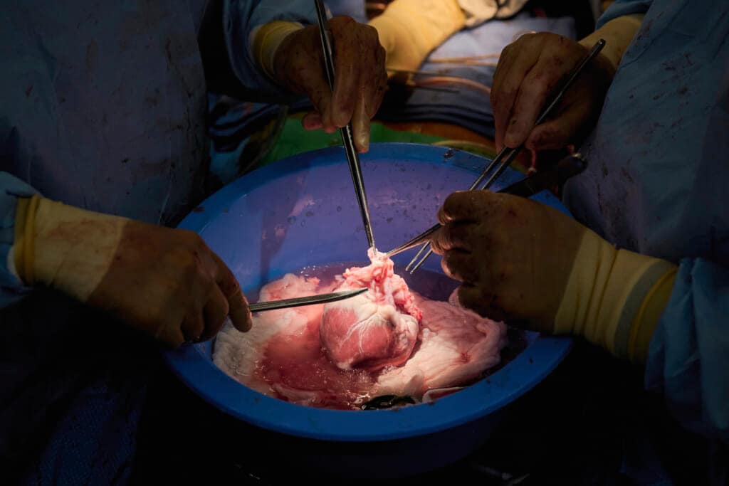 Pig hearts sewn into brain-dead people furthers research for saving humans with animal organs