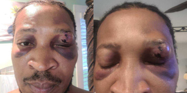 ‘I Thought You Had His Shoulder!’: Georgia Man Dropped on His Head, Suffers Permanent Eye Damage After Cops Learned He Had Unpaid Child Support  —  Except They Were Wrong