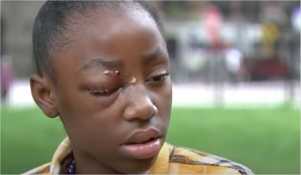 ‘I Almost Blacked Out’: Chicago 11-Year-Old Was Beaten So Bad By Two Adult Women She Has to Get Two Eye Surgeries; No Arrests Made