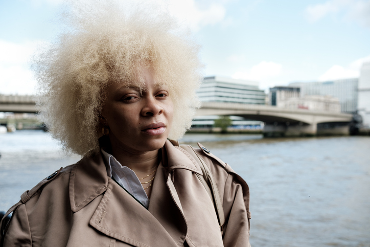Black People With Albinism: Challenging Beauty Norms & Stereotypes