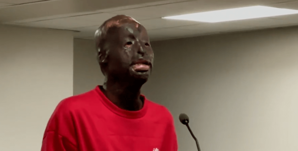 Burn Survivor Denies Murder Charge: ‘These Hands Can’t Pull A Trigger’