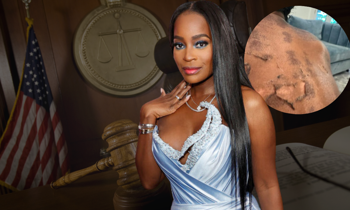 RHOA Star Shamea Morton Sues Atlanta Doctor After Chemical Peel Allegedly Leaves Scars