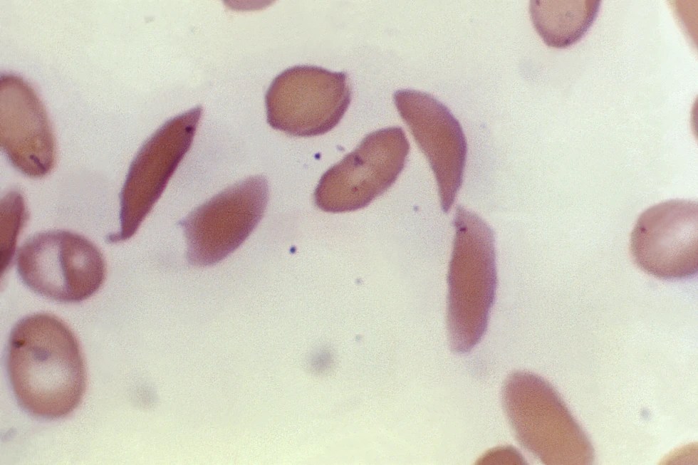 First Louisiana patient treated with gene therapy shows early promise in sickle cell fight