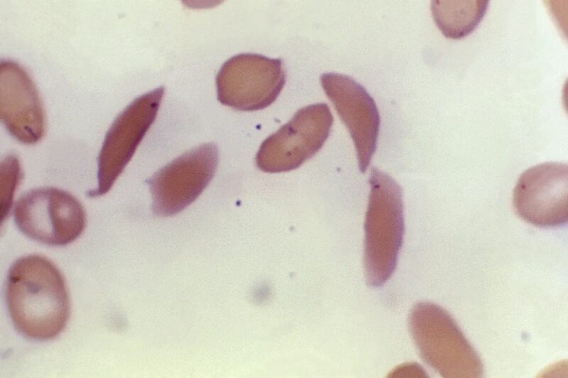 ‘Life two’: Louisiana man becomes first in state to be functionally cured of sickle cell disease